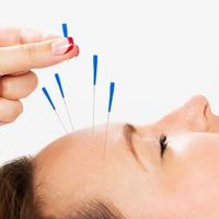 Acupuntura YNSA en valencia Centro Osteopático TEM