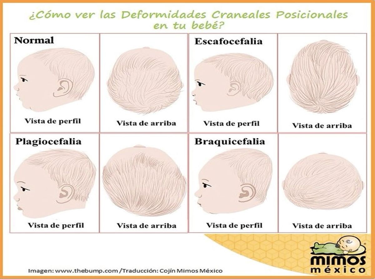 Bebé, plagiocefalia, deformidad de la cabeza
