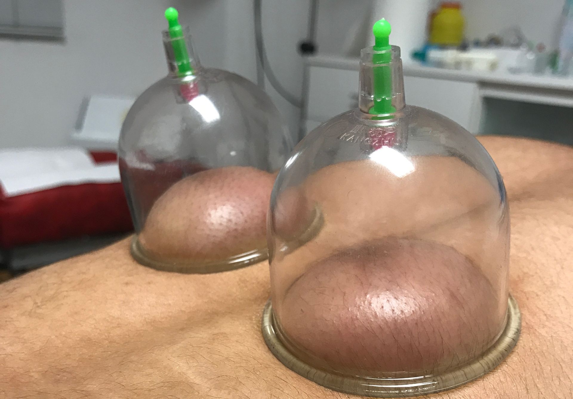 servicio Cupping Centro Osteopático TEM